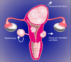 Ein myom der gebärmutter ist eine gutartige geschwulst , die sich aus muskelzellen der gebärmutter entwickelt. Aktuell 047 Neues Behandlungsverfahren Fur Uterus Myome Im Rkk Gefasszentrum Bremen