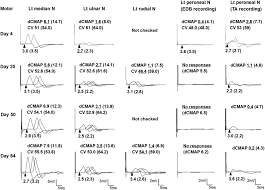 Check spelling or type a new query. Hemiparetic Guillain Barre Syndrome Journal Of The Neurological Sciences