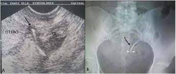 Dispositivo Intrauterino Migrado A La Cavidad Abdominal Con Embarazo Intrauterino No Evolutivo Reporte De Caso