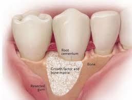 Pearl powder contains dozens of minerals, including: Periodontal Disease Treatment Central Texas Periodontics