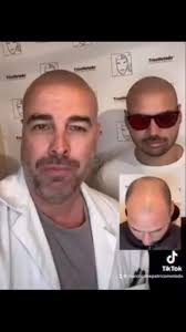 ADDIO CALVIZIE 🙋🏻‍♂️ Marco Canepa Marco Canepa Tricopigmentazione  TricoMetodo Tricopigmentazione