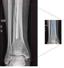 Image result for Osteomyelitis