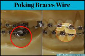 Orthodontists are trained to know how to exactly bend the arch wire. Poking Braces Wire Why This Happens How To Stop Orthodontic Braces Care