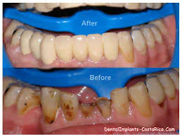 Aesthetic dental specialises in micro enamel polishing, a highly requested service using a technique specifically developed by dr. Aesthetic Dentistry In Costa Rica Cosmetic Dentistry In Costa Rica Dental Implants In Costa Rica