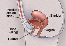 Stress Urinary Incontinence Having Midurethral Sling Surgery