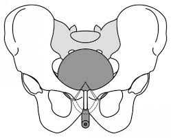 Sling Surgery With Fascial Or Natural Tissue Slings For Stress Urinary Incontinence Sui