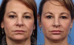 5 steps to sculpting your cheeks with makeup. Cheek Fillers Dermal Filler Cheek Injections Rejuvent Scottsdale