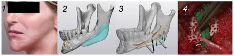 Reconstruction of Craniomaxillofacial Bone Defects with 3D-Printed  Bioceramic Implants: Scoping Review and Clinical Case Series
