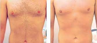 Looking for laser hair removal in melbourne cbd? Men S Laser Hair Removal Melbourne Collins Cosmetic Clinic