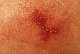 Image result for genital herpes
