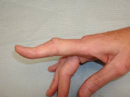 Mallet finger is an injury to the end of your finger that causes it to bend inwards towards your palm. Boutonniere Finger Deformity From Tendon Injury