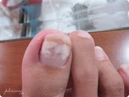 Toe Nail Fungus Code White Spots On Nails White Spots On Toenails White Patches On Nails