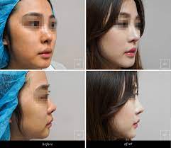 What is the recovery time for a nose job? Before And After Nose Surgery Photos Sk Plastic Surgery