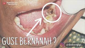 Gigi bungsu merupakan gigi geraham ketiga dan geraham terakhir yang tumbuh. Cabut Gigi Geraham Bawah Dokter Gigi Youtube