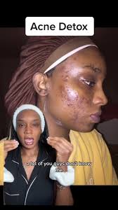 Aztec Clay Mask Review: Best Skincare Routine for Acne