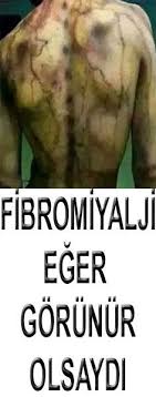 Fibromiyalji noktaları ile ilgili bu madde bir taslaktır. Fibromialji Icin 30 Fikir Fibromiyalji Saglik Saglikli Yasam