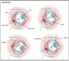 Check spelling or type a new query. Scleral Buckling Procedure Recovery Removal Pain Complications Time Infection Medication