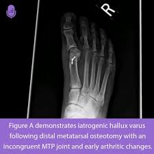 Image result for Hallux Varus