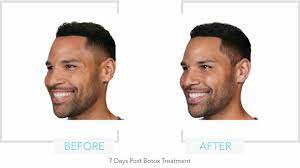 Botox San Rafael The Laser Center Of Marin Location