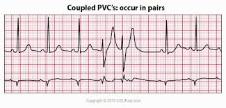 Premature ventricular complexes are also referred to as premature ventricular beats, premature ventricular contractions or just ventricular healthy individuals might display premature ventricular complexes on ecg during screening. Ekg Ecg Interpretation Course Ceufast Nursing Continuing Education