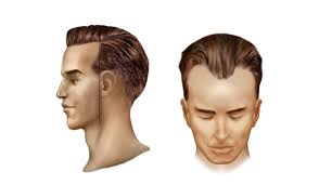 علاج صلع مقدمة الرأس عند الرجال عن طريق زراعة الشعر دكتور احمد مكاوي