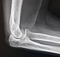 Image result for Elbow XRay