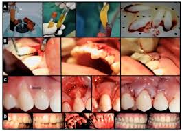There are three types of matrix organizations Platelet Rich Fibrin Prf Regeneration Portland Perio Implant Center