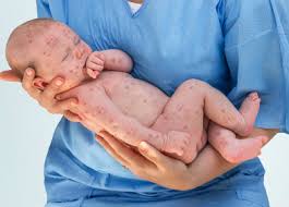 Très rare chez les adolescents et les. Maladies Infantiles Varicelle Rougeole Roseole Rubeole Bronchiolite