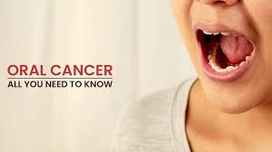 Image result for dental cancer