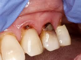 If you have a slight pain when you're eating, check for holes. Tooth Decay On The Root Surface Mccarl Dental Group