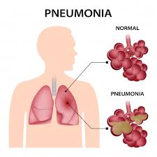 Image result for Pneumonia