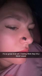 What to do about a bleeding nose piercing?