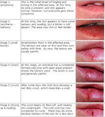 How To Reduce The Visible Signs Of Cold Sore Cold Sores Are Group Of Fluid Filled Blisters That Devel Cold Sore Stages Cold Sores Remedies Cold Sore Treatment