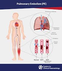 How do doctors confirm a pulmonary embolism? Pulmonary Embolism Cfch Centre For Clinical Haematology
