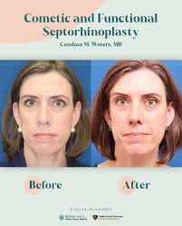 Before and After Cosmetic and Functional Septorhinoplasty Whether you're  looking to improve breathing by correcting a deviated septum or enhance the  appearance of your nose, septorhinoplasty offers a transformative solution.  By working
