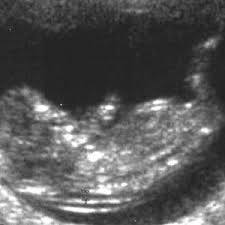 How is anembryonic pregnancy miscarriage different from a missed miscarriage? What Is A Blighted Ovum Babycenter India