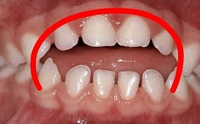 How to fix an overbite: What Thumbsucking Does To Teeth Quora