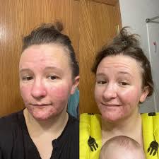 Week 21 post op 51lbs lost! Yay 🤩 Has anyone else found that their self  care and looking after themselves has improved since having the op? I now  have my nails done,