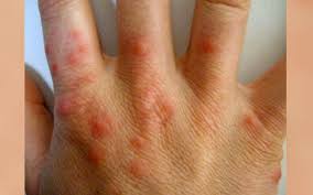 Bed bugs are one of the most difficult pest problems to eradicate quickly. Bed Bugs Bugging You Destroy Them Free Malaysia Today Fmt