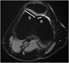Image result for Patella Tracking Assessment