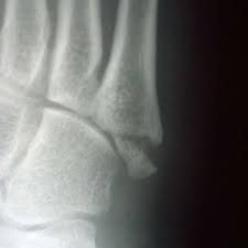 A fracture in the fifth metatarsal (located on the outside of the foot) can occur anywhere along the bone, but most often. Radiograph Of A Zone One Fifth Metatarsal Fracture Download Scientific Diagram