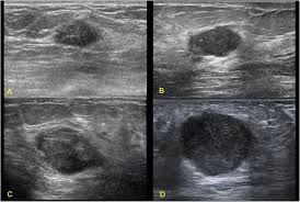 The use of ultrasound for breast cancer screening. Triple Negative Invasive Breast Carcinoma The Association Between The Sonographic Appearances With Clinicopathological Feature Scientific Reports