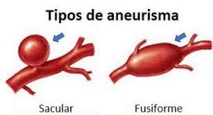 Un aneurisma cerebral o aneurisma de una arteria cerebral (del latín aneurysma, dilatación) es una enfermedad cerebrovascular en la cual una debilidad en la pared de una arteria o vena ocasiona una dilatación o abultamiento de un segmento localizado en la pared del vaso sanguíneo y esta. Aneurismas Cerebrais Dra Raquel Zorzi