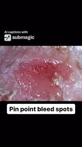 Image result for Auspitz Sign