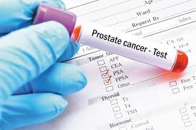 blood in the urine (hematuria) or semen. New Ways To Test For Prostate Cancer Harvard Health