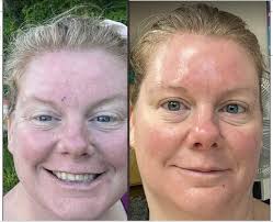 Kandel v Dr Dennis Gross Skincare Settlement Payments