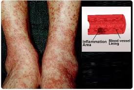 Image result for Microscopic Polyangiitis