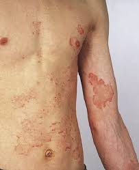 Tinea Pedis Tinea Cruris Tinea Corporis Athlete S Foot Jock Itch Ringworm Anesthesia Key