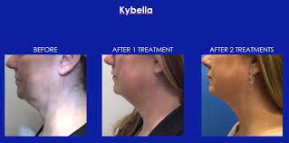 A double chin can become more evident as you age or put on weight and can also affect your confidence. How Can I Get Rid Of My Double Chin Dy Dermatology Center