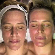 Benefits of monthly professional facials for skin health